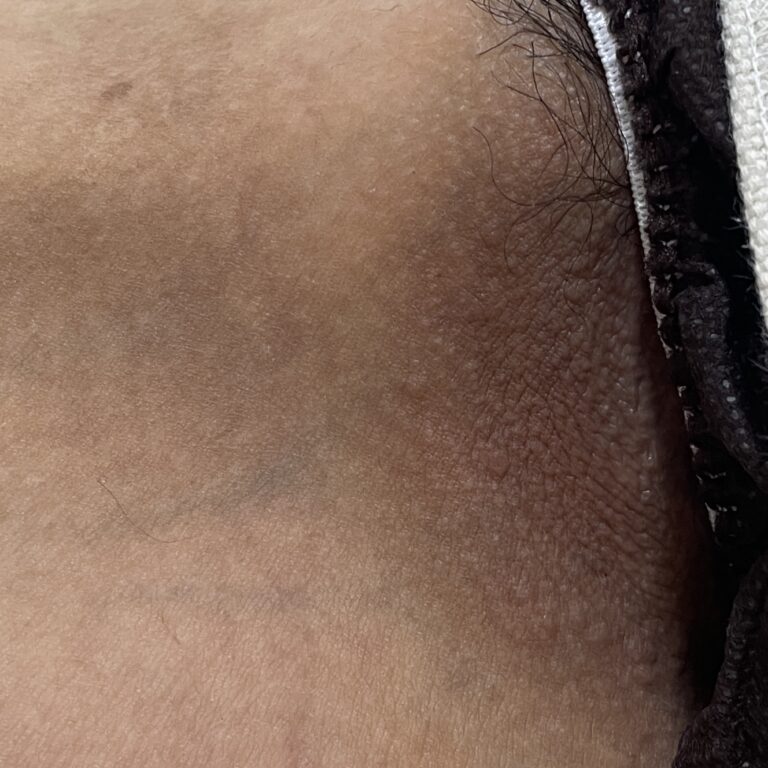 VIOの施術前